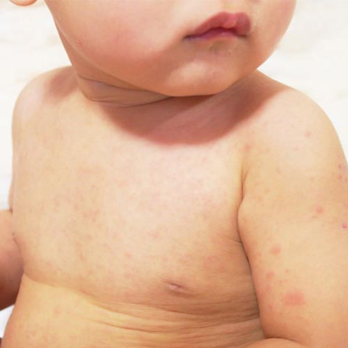 乳児湿疹って？アトピーとの違いは？ 赤ちゃんの肌荒れの原因とケア方法